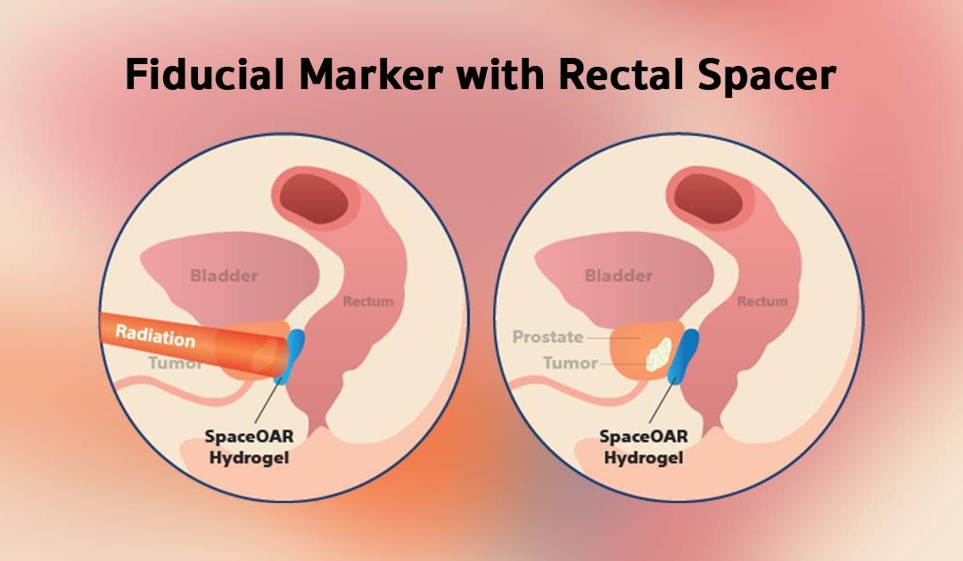 Fiducial Marker with Rectal Spacer