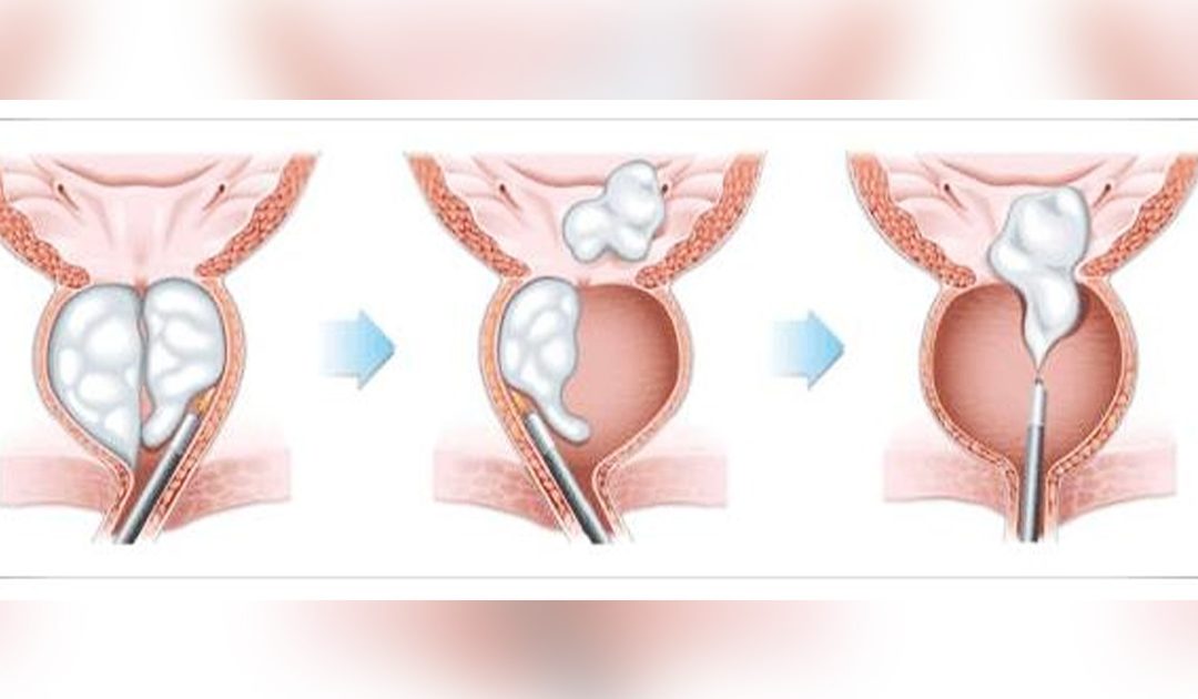 What is laser prostate surgery (HoLEP) and what are the benefits?